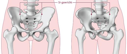 Klachten bij axiale spondyloartritis
